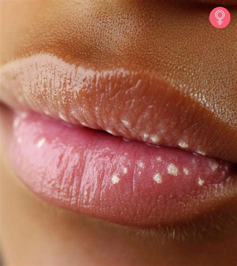 Small White Dots On Lips