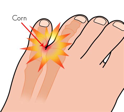 Soft Corn Between Toes