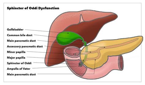 Sphincter Of Oddi Dysfunction