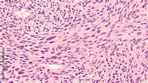 Spindle Cell Sarcoma