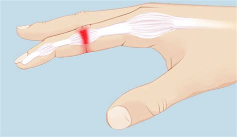 Sprain Or Break Finger