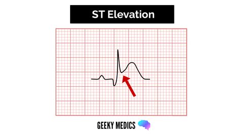 St Elevation