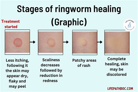 Stages Ringworm Healing