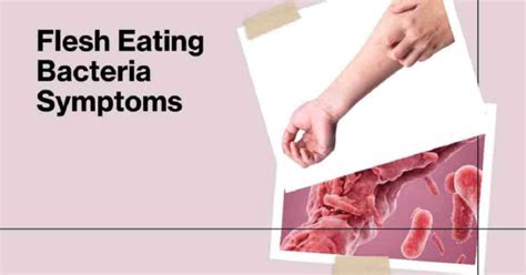 Symptoms Of Bacteria Eating Flesh