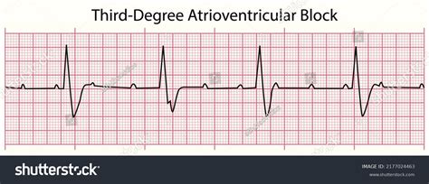 Third Degree Heart Block Complete