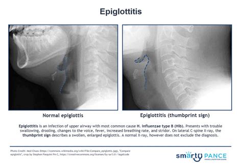 Thumbprint Sign Epiglottitis