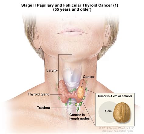 Thyroid Carcinoma Surgery