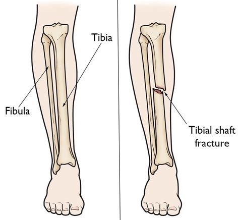 Tibia Bone Fractures