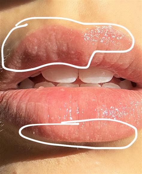 Tiny Clear Blisters On Lips