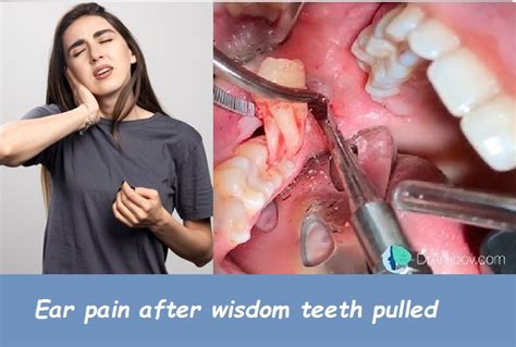 Tooth Pulled Pain