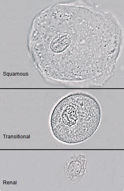 Transitional Epithelial Cells In Urine