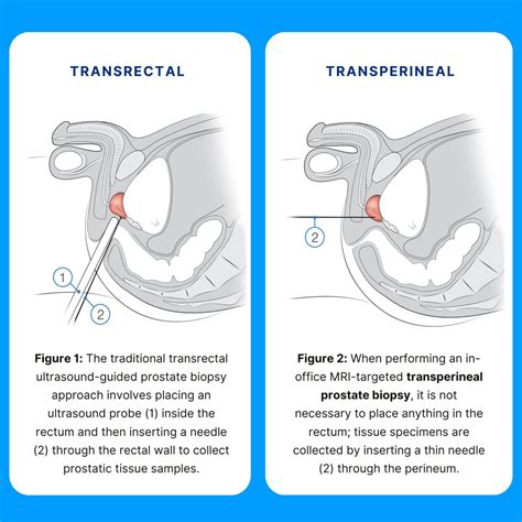Transperineal Prostate Biopsy