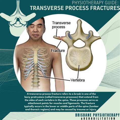 Transverse Process Fracture