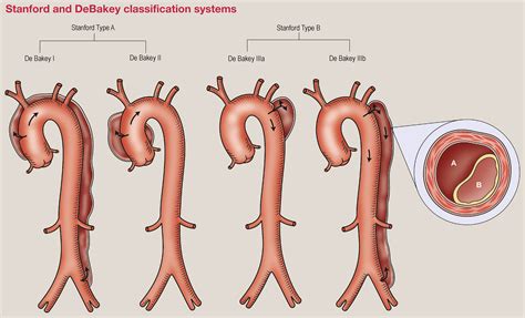Type B Aortic Dissection