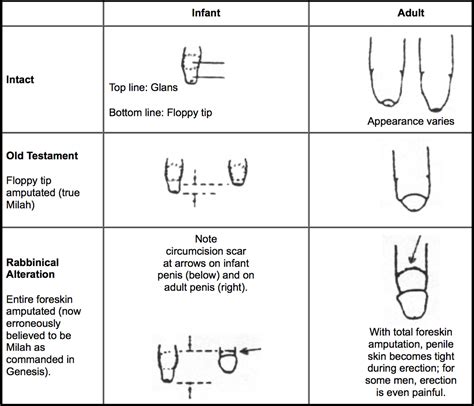 Types Of Circumcision