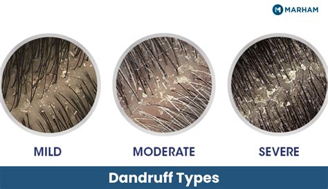 Types Of Dandruff