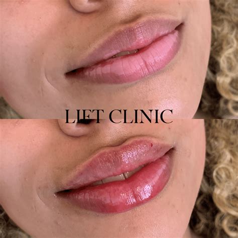 Types Of Lip Fillers