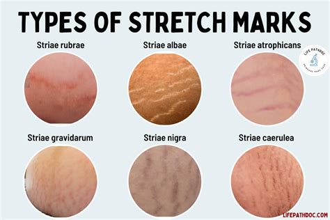 Types Of Stretch Marks