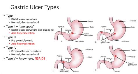 Types Of Ulcers