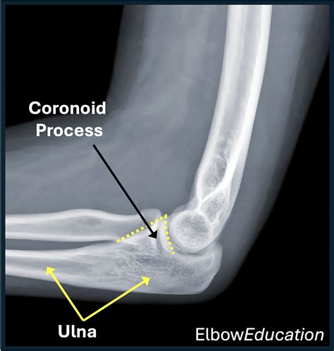 Ulnar Coronoid Process