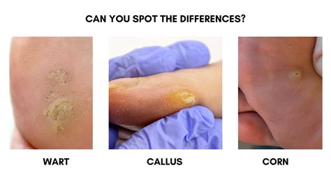 Warts Or Calluses
