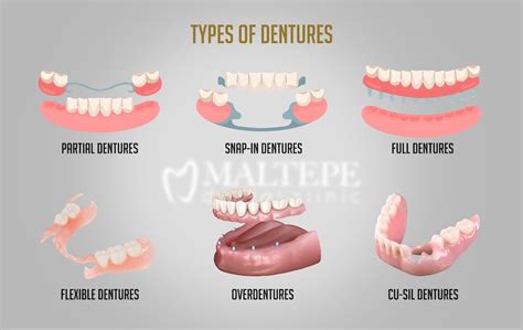 What Are Dentures