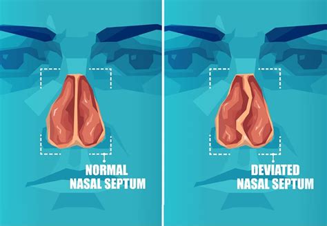 What Causes A Deviated Septum