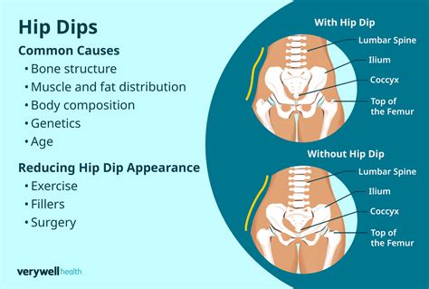 What Causes Hip Dips