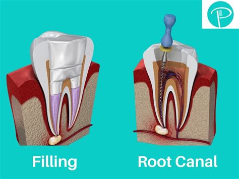 What Causes Root Canals