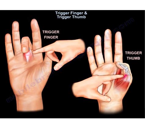 What Causes Trigger Finger