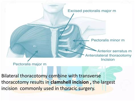 What Is A Thoracotomy
