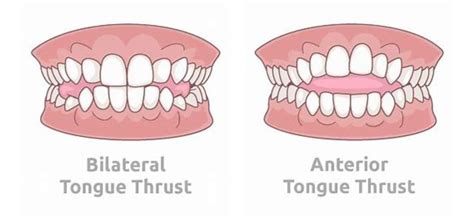 What Is A Tongue Thrust