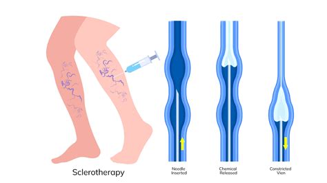 What Is Sclerotherapy