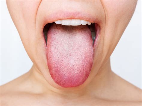 White On Tongue