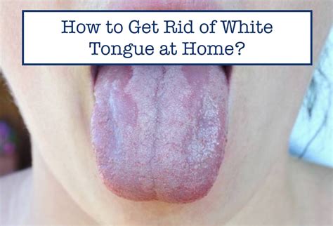 White Paste On Tongue