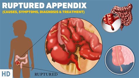 Why Do Appendix Burst