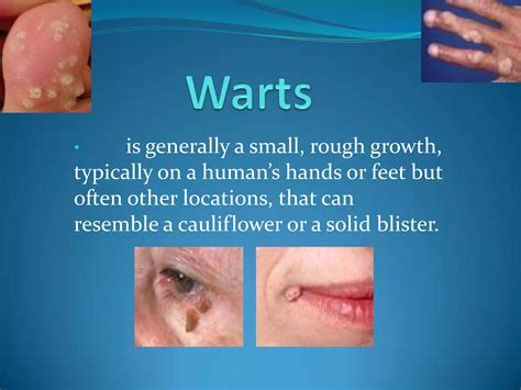 Why Do Warts Form