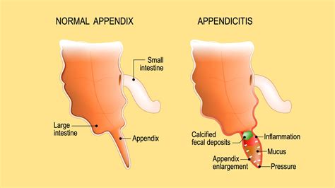 Why Does The Appendix Burst