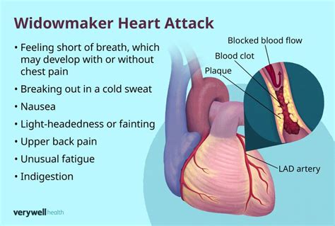 Widowmakers Heart Attack