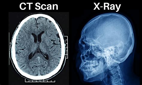 Xray And Ct Scan Difference