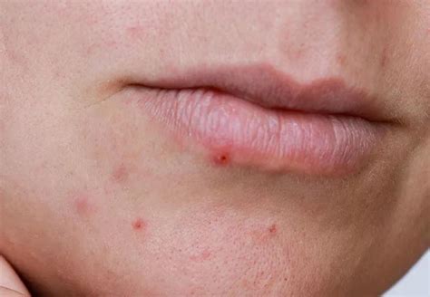 Zit On Lip Line